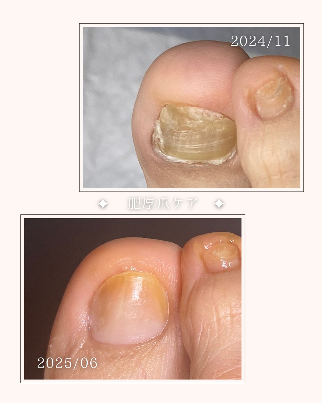 肥厚爪が少しずつ…🌞