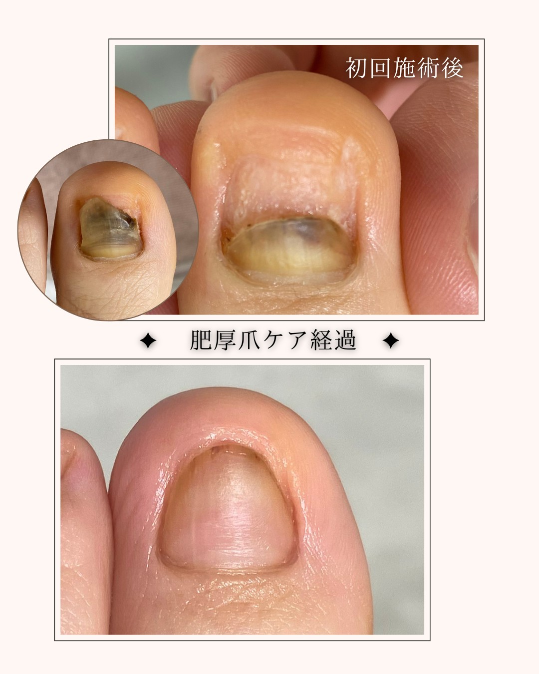 厚くなった爪が・・・👣✨