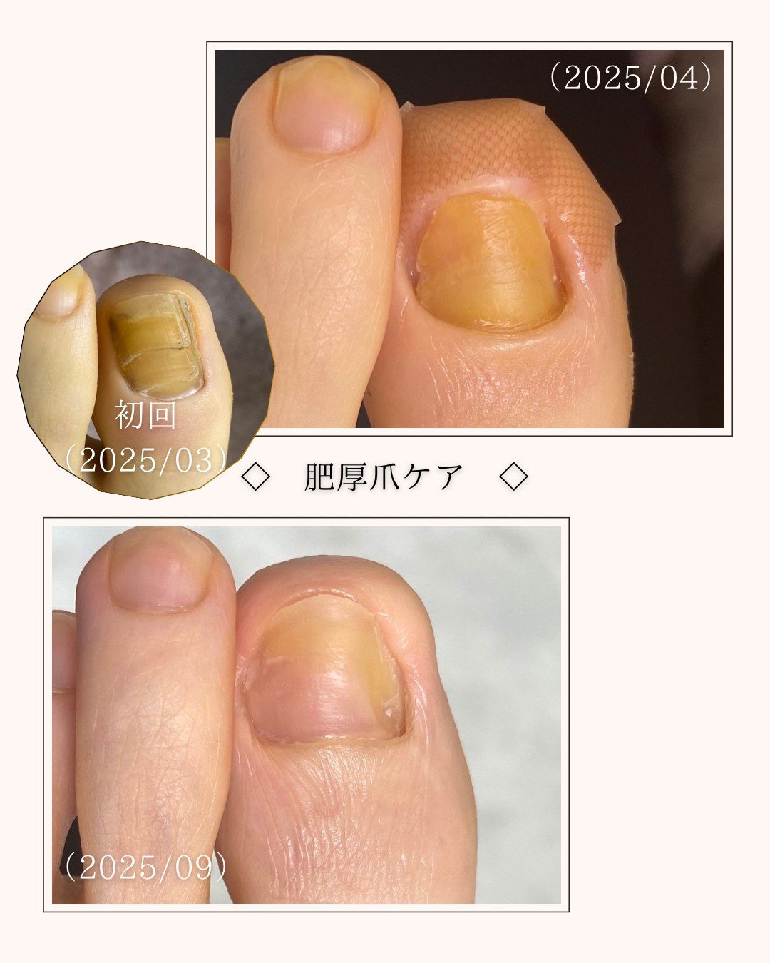 巻き爪の手術をされてから厚い爪になってしまった🌀